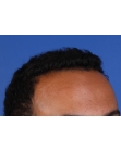 After Hair Transplant&nbsp;Front